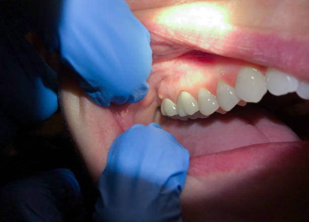 Best Emergency Wisdom Teeth Removal in Greenbelt, MD